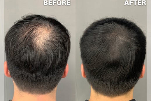 comparision of effect of pmu before and after procedure