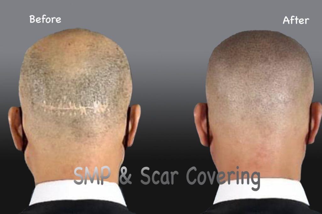 comparision of effect of pmu before and after procedure